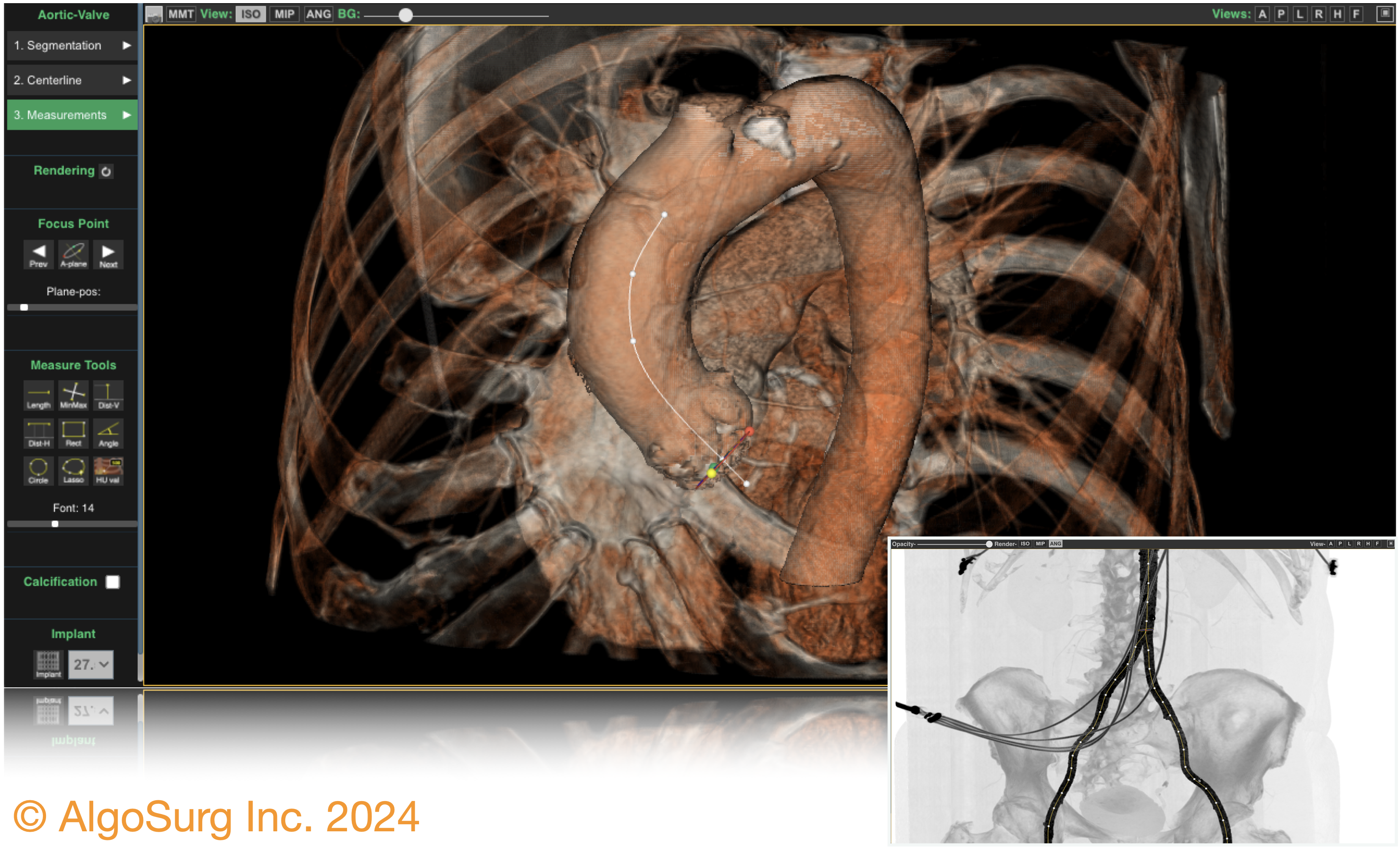 Cardio-Vascular Surgery Planning