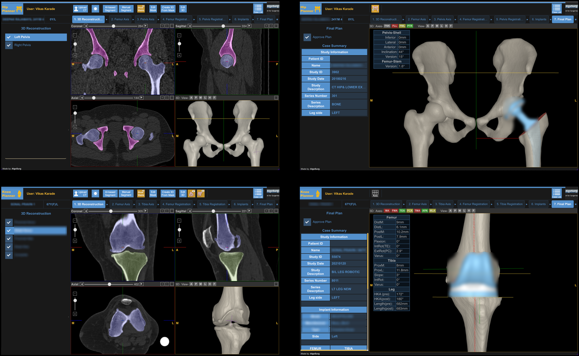 Algosurg's Robotic Surgery